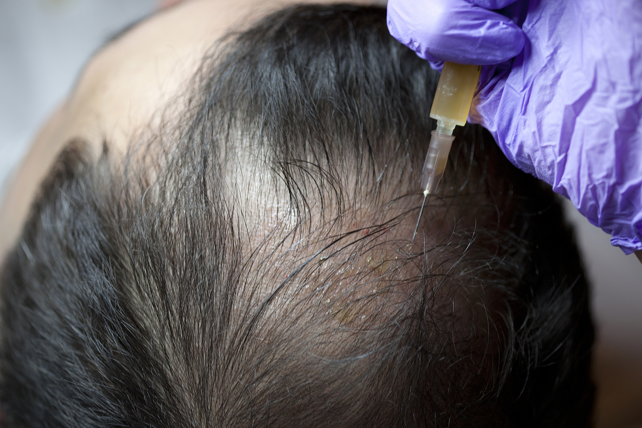 Things to beware of before undergoing hair restoration processes