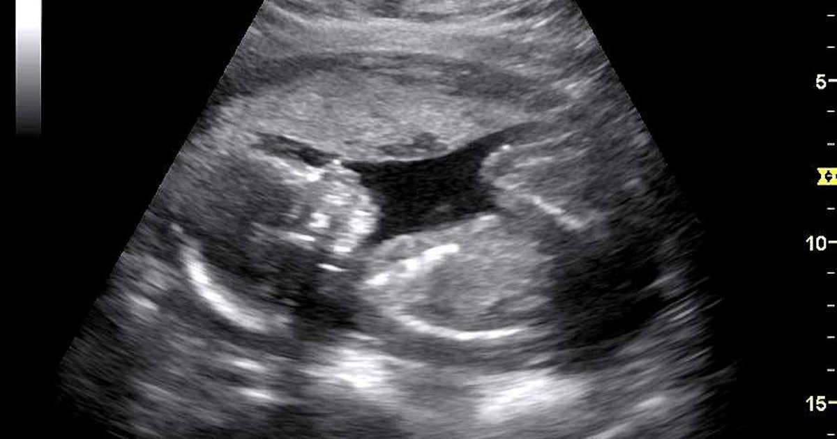 Suggestions on recognizing fake ultrasound